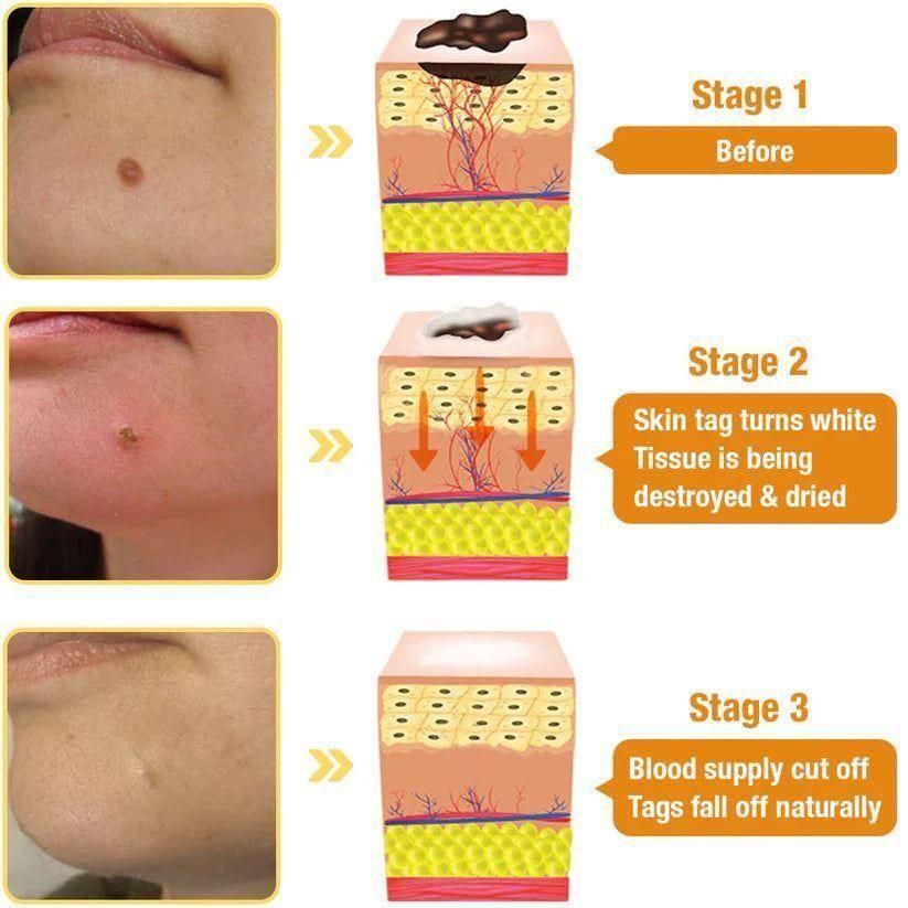 Bee Venom Wart Remover Spray (BUY 1 GET 1 FREE)